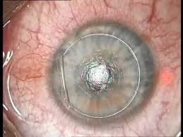 Figure 6Lasik flap lifted from the cornea before the excimer laser is used to reshape the underlying cornea