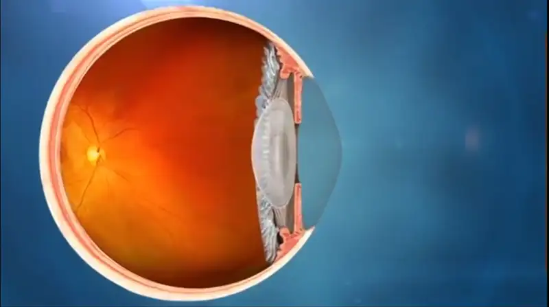 Cataract Surgery Lens Implantation Video