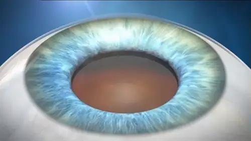 SMILE Laser Vision Procedure Video